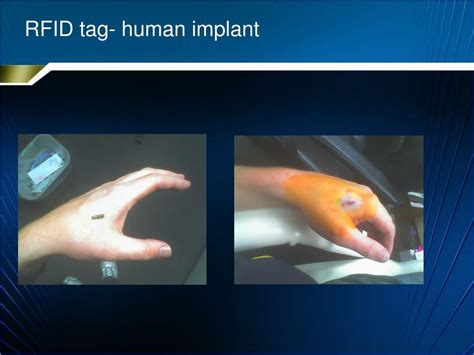 will a vet rfid scanner work on a human rfid|rfid implant fullness.